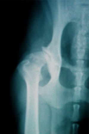 Radiograph of Hip Dysplasia